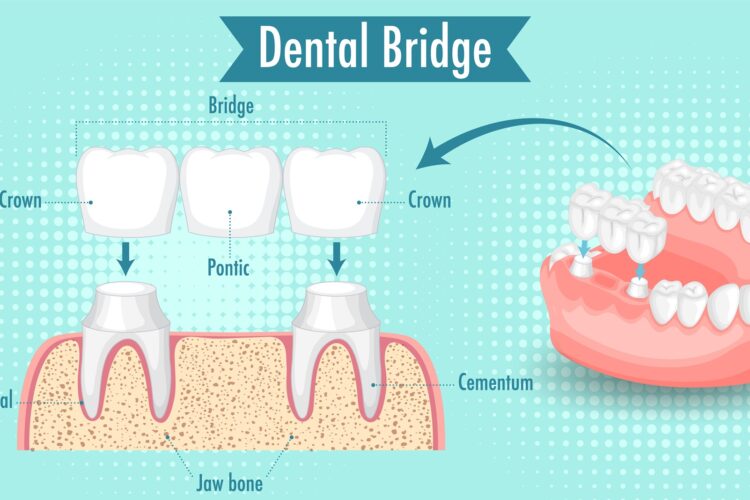 Dental Bridges
